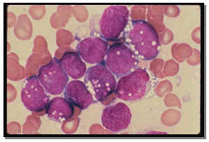 leucemia al microscopio