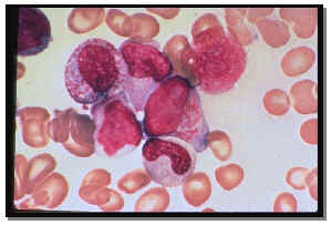 leucemia al microscopio